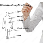Understanding Diabetes Complications: Beyond Blood Sugar Levels
